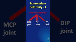 Shorts 83 Boutonniere deformity  what is it Explained in less than a minute [upl. by Dew471]