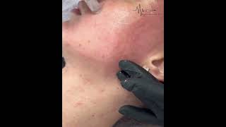 Microneedling explained [upl. by Kancler]