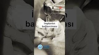 İmplantın bağlanılması [upl. by Martijn]