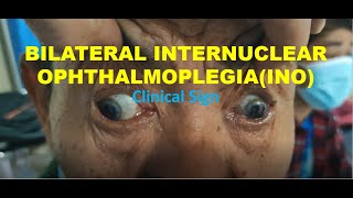 Bilateral Internuclear Ophthalmoplegia INO  WEBINO  EBINO  Clinical Sign  Neurology [upl. by Katerina]