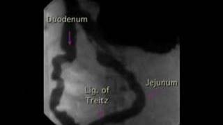 Lower GI Movies  Duodenal Peristaltic Waves [upl. by Mackey]