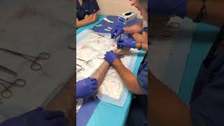 Posterior Tibial Tendon Transfer Dr Edgardo RodriguezCollazo [upl. by Ahsennod731]