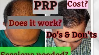 PRP for hair losshow it workscostDOs ampDonts [upl. by Nosmirc547]