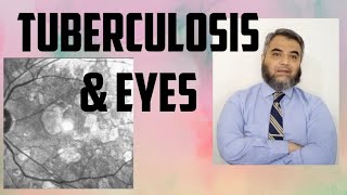 TUBERCULOSIS AND EYES Tuberculosis EyeinfectionRifampicinisoniazidethambutol [upl. by Narok553]