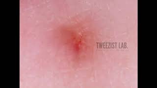 Plucking ingrown hairs 매몰모인그로운 헤어 뽑기 [upl. by Aidiruy]