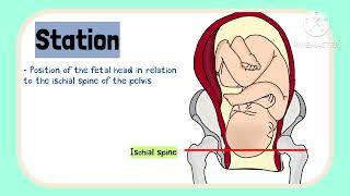 Bishop Score Induction of labour in pregnancy Obstetrics [upl. by Eseyt238]