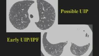 HRCT of Diffuse Lung Disease  HD Basic Radiology [upl. by Oisacin72]