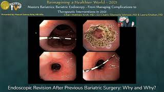 Endoscopic Revision After Previous Bariatric Surgery Why and Why [upl. by Rihsab916]