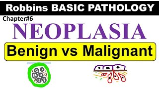 Chp6Part2 Robbins Basic Patho  Characteristics of BENIGN amp MALIGNANT Neoplasms General Pathology [upl. by Sawyere]