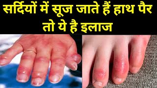 सर्दियों में हाथ पैर सूजन Home Remedy for RednessSwelling Fingers sardi me hath par sujan ka ilaj [upl. by Gnoy956]