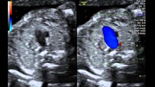 Tetralogy of Fallot with pulmonary atresia [upl. by Isolda80]