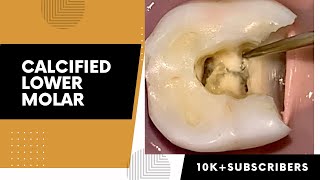 Decayed and Calcified Mandibular Molar Access Opening [upl. by Lehte823]