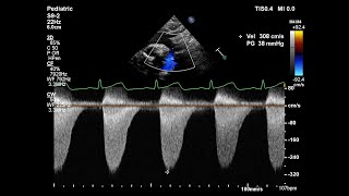 Basic echocardiography심장 초음파 기본  Coarctation of aorta대동맥 축착 [upl. by Mharg]