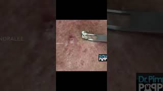 Dr Pimple Popper Goes Digging [upl. by Spike235]