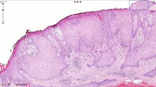 Clear Cell Acanthoma  Skin Histopathology [upl. by Diehl]