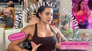 1 Year POSTOP Rapid Recovery Breast Augmentation  Boobies  Bodybuilding QA BEFORE AND AFTER [upl. by Trah37]