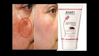 Jovees Anti Blemishes Pigmentation Cream pigmentation ka 100 Elaj Agar pigmentation se paresan h [upl. by Theona]