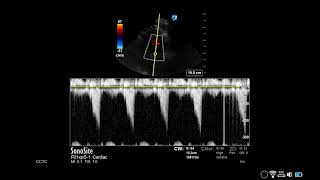 How to Measure LVOT Obstruction [upl. by Enilrad]