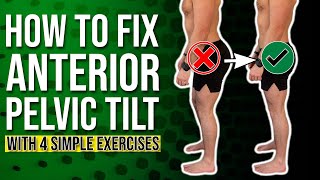 Anterior Pelvic Correction Exercises  The 4 BEST Ones You Can Do [upl. by Suilenrac695]