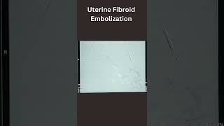 Uterine Fibroid Embolization [upl. by Gerdeen]