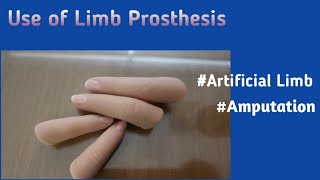 Use of Limb Prosthesis Artificial Limb amputation high Votage Electric Burn [upl. by Aronow594]