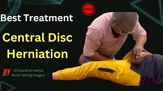 A Central Disc Herniation Is A Rare Condition  Disc Herniation Recovery [upl. by Aronow]