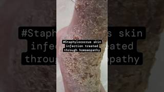 Staphylococcus skin infection  Dr Manjunath Rao M skincare skin homoeopathy bhms glucose [upl. by Aneev628]