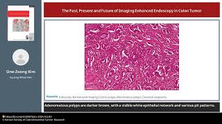 The Past Present and Future of Imaging Enhanced Endoscopy in Colon Tumor [upl. by Akinaj]