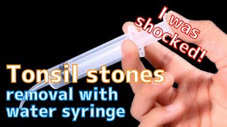 Tonsil stones removal with water syringe [upl. by Mcquillin]