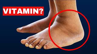 1 Vitamin vitamin that helps reduce swelling [upl. by Ros]