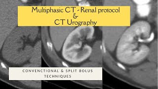 MULTIPHASIC RENAL CECT PROTOCOL  SPLIT BOLUS TECHNIQUE CT UROGRAPHY Triple bolus technique [upl. by Sofko953]