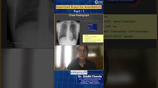 Important Xrays for Anesthetists by Dr Siddhi Chawla [upl. by Llenad]