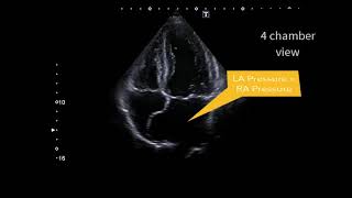 Atrial septal aneurysm [upl. by Rafaelita]