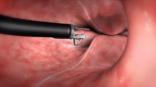 What Happens During the Endoscopic Sleeve Gastroplasty ESG Procedure [upl. by Naejeillib803]