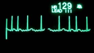 Atrial Fibrillation with RVR [upl. by Marilee]