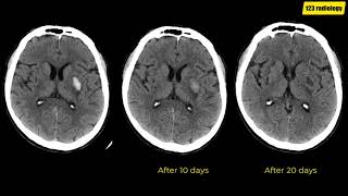 Stages of intracerebral hemorrhage in CT [upl. by Seravat]