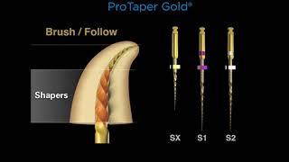 Canal preparation with ProTaper Gold®  Dentsply Sirona [upl. by Romy]