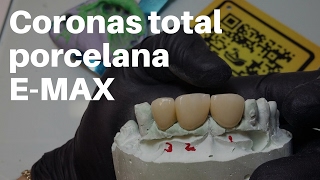 Coronas Dentales EMax TOTAL PORCELANA👅PASOS para CementaciónAdhesión CoronasDentales [upl. by Manoff]