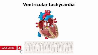 Ventricular Tachycardia [upl. by Adler]