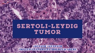 SertoliLeydig Tumor and DICER1syndrome [upl. by Afatsom]