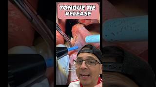 Tongue Tie Release Procedure on Adult  In Office to Hands On Dental Training shorts [upl. by Neenahs960]