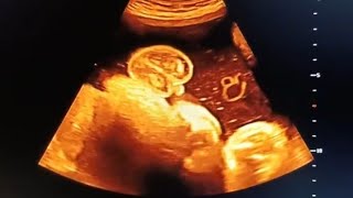 Boy or girl baby ultrasound subscribe babyboy babyb [upl. by Nwahsal]