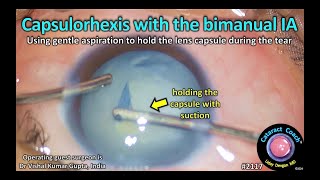 CataractCoach™ 2117 capsulorhexis with the bimanual IA [upl. by Novahc]