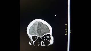 Left cerebral acute infarctmass effectcontra lateral midline shift subfalcine herniationsequele [upl. by Gillette]