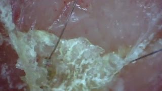 Peeling Scabs Under Magnification [upl. by Irianat200]