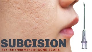 Subcision for Acne Scars  Advanced Dermatology amp Laser Institute of Seattle [upl. by Jeminah339]