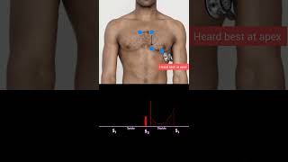 What Murmur is This MRCP PACES Quiz This patient presented with breathlessness [upl. by Milurd]