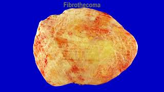 Solid ovarian tumors 22  Fibroma amp Thecoma [upl. by Falkner]