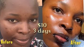 How I accidentally healed my skin barrier in just 3 days [upl. by Novart33]