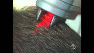 HairMax LaserComb tested on Dateline NBC  The Follicle 5  Part 5 [upl. by Avin]